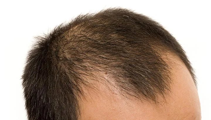 Hair Loss Among Men and Its Alarming Impact on the Younger Generation - Menscrafted