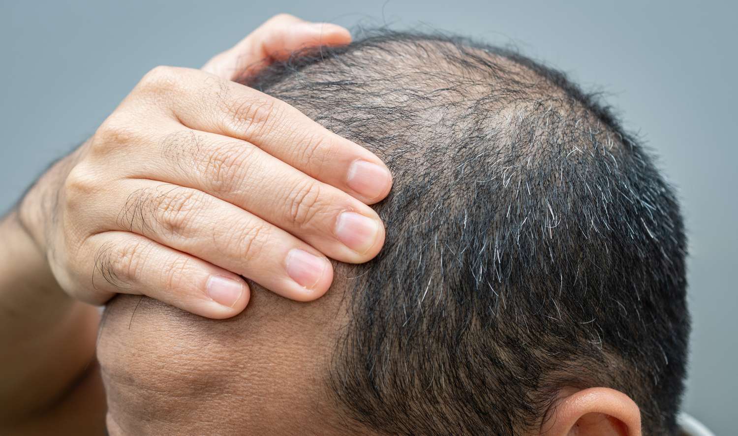 Types of Hair Loss in Men and Proven Steps to Combat It - Menscrafted
